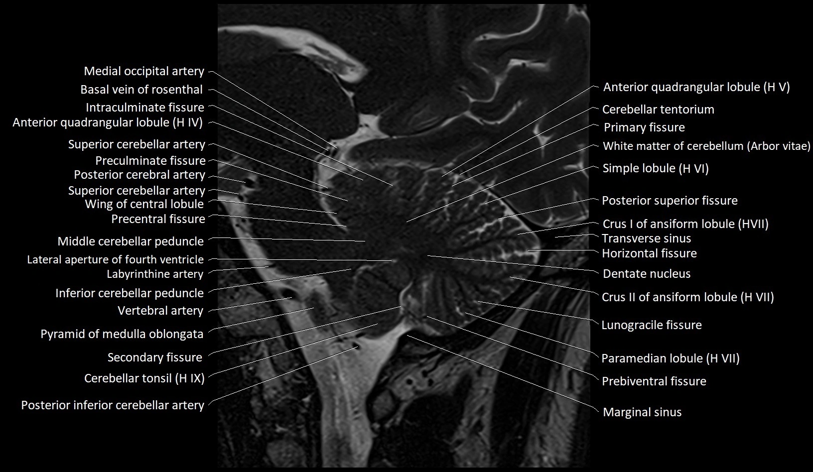 MRI Cerebellar anatomy sagittal High-resolution labelled image 24.webp